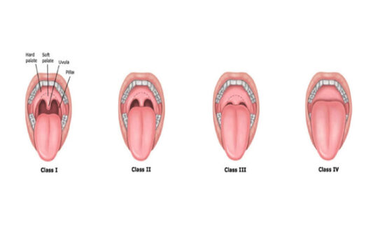 ADENOIDS / TONSILLITIS COMPLEMENTARY MANAGEMENT - Union Yoga Ayurveda
