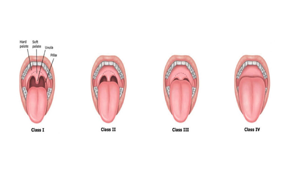 ADENOIDS TONSILLITIS