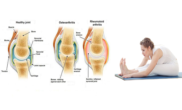 ARTHRITIS
