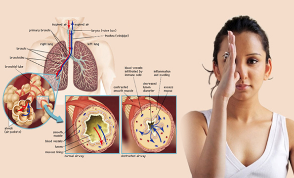 BRONCHIAL ASTHMA