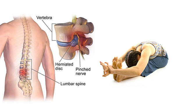 SPONDYLOLISTHESIS VERTEBRA SLIP