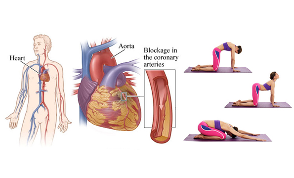 Cardiovascular Disease