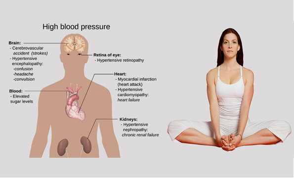 High Blood Pressure and Yoga Therapy
