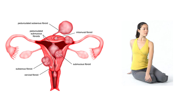 UTERINE FIBROIDS YOGA THERAPY
